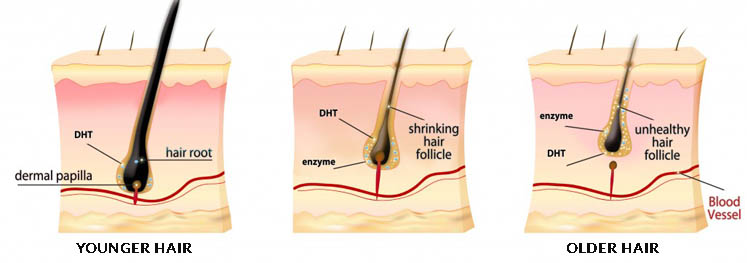 Follipur directly injects highly effective hair growth nutrients into hair follicles and the dermis layer.